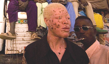 UN rights experts urge Malawi to protect people with albinism